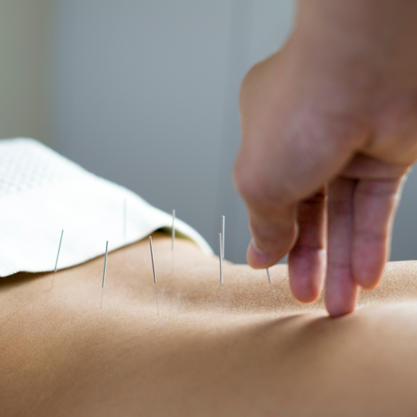 acupunture therapy